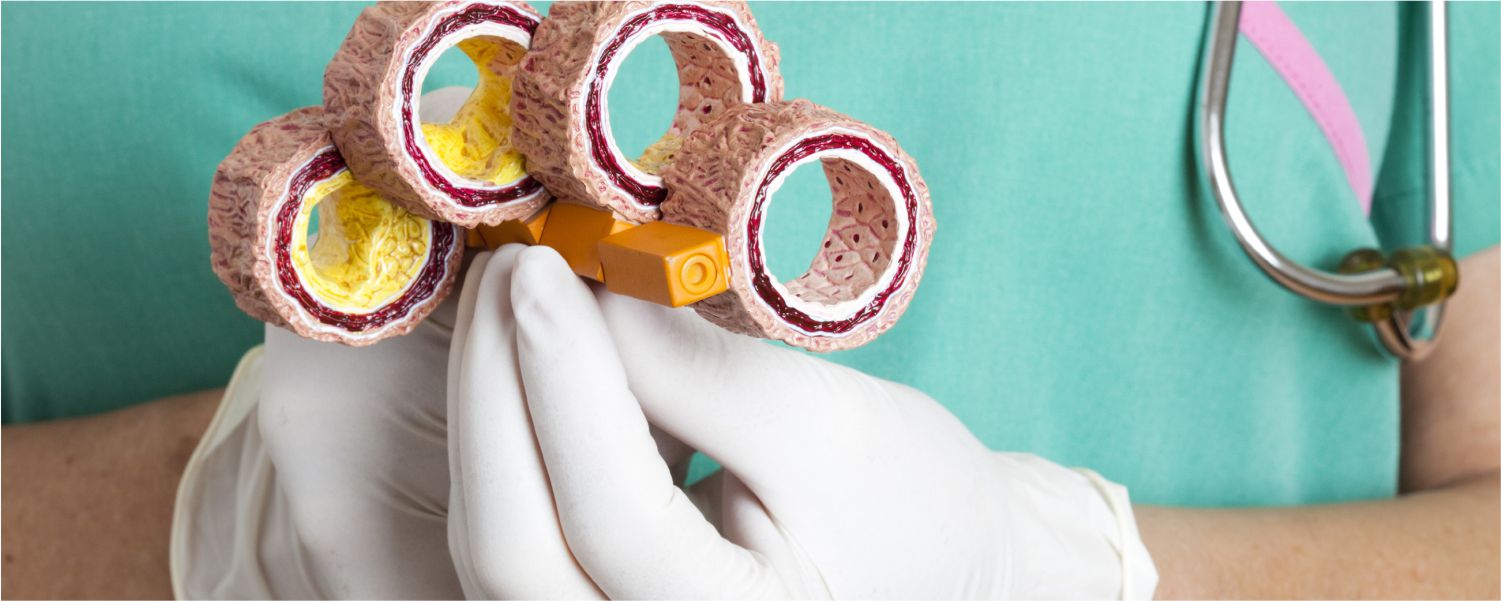 Control y manejo del colesterol alto en adultos