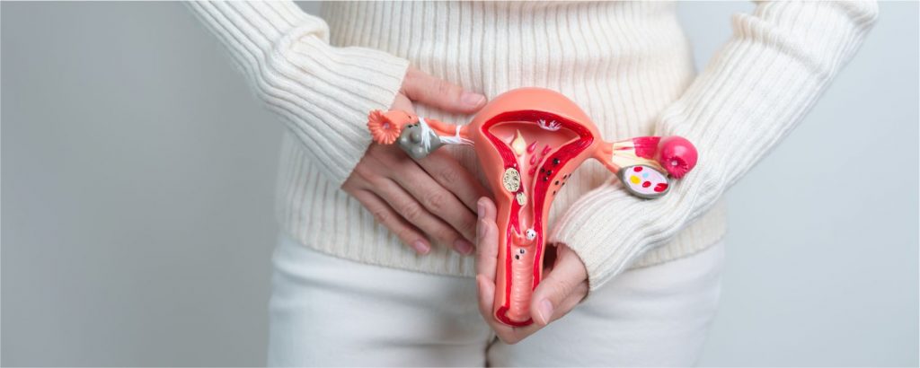 Endometriosis: Diagnóstico temprano para mejorar la calidad de vida