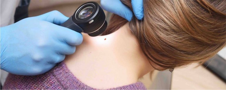Prevención del cáncer de piel: Protección y chequeos regulares